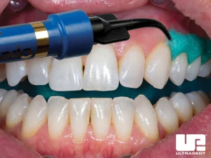Securely attach recommended tip to an OpalDam™ resin barrier syringe and check flow. Express a continuous bead along the gingival margin, overlapping approximately 0.5 mm onto the enamel. Begin and finish the bead one tooth beyond the most distal tooth that is being whitened. Express the resin through any open embrasures.