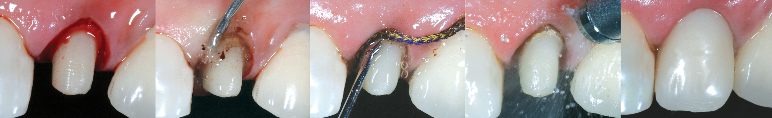 ViscoStat Clear Hemostatic Gel